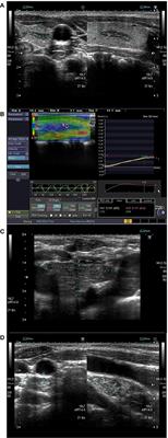 Sonographic and Elastographic Features of Extra- and Intrathyroidal Ectopic Thymus Mimicking Malignancy: Differential Diagnosis in Children